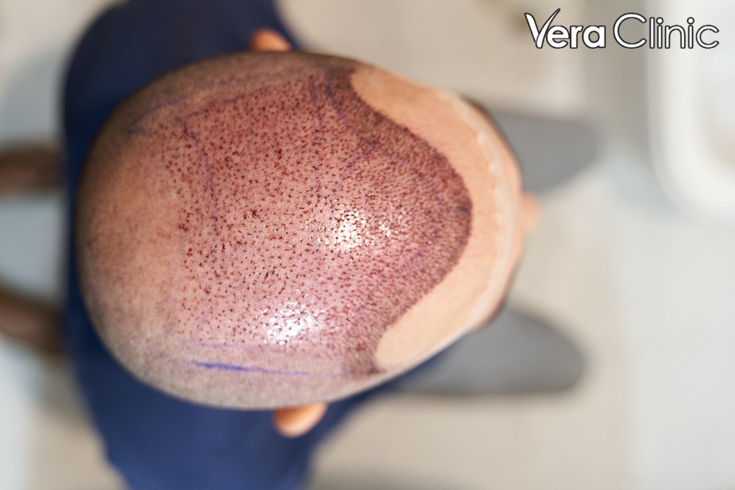 hair graft turkey